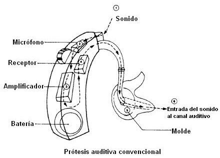 COMPOSICION-AUDIFONO-BTE