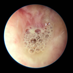 otitis 1