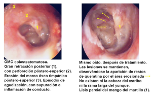 omc colesteatomatosa