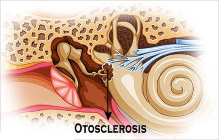 OTOSCLEROSIS Y SORDERA - Audix